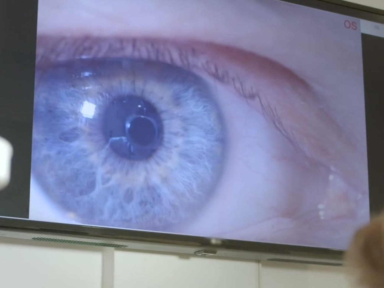 Exploración de la superficie ocular con lámpara de hendidura